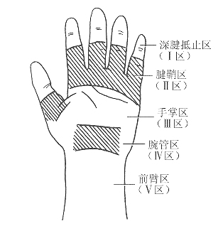 屈肌腱损伤的治疗方法