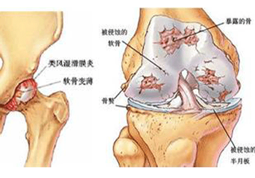 关节外科 滑膜炎        福州中德骨科专家指出:滑膜炎好发于关节部位