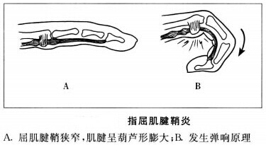 什么是手指屈肌腱腱鞘炎